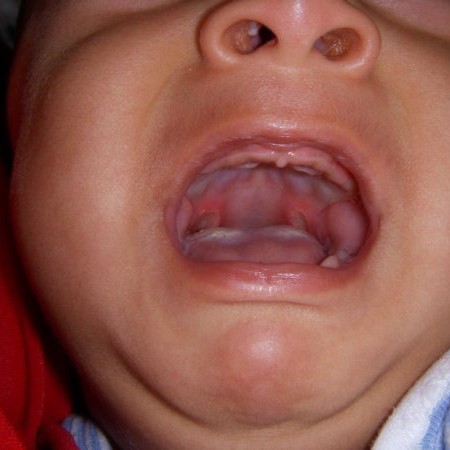 hand foot mouth infant #10