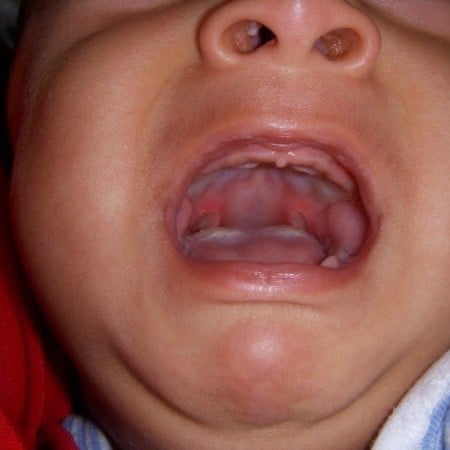 Mom Seeks Diagnosis For Baby S Undiagnosed Rare Disease That Causes Painful Mouth Ulcers Global Genes
