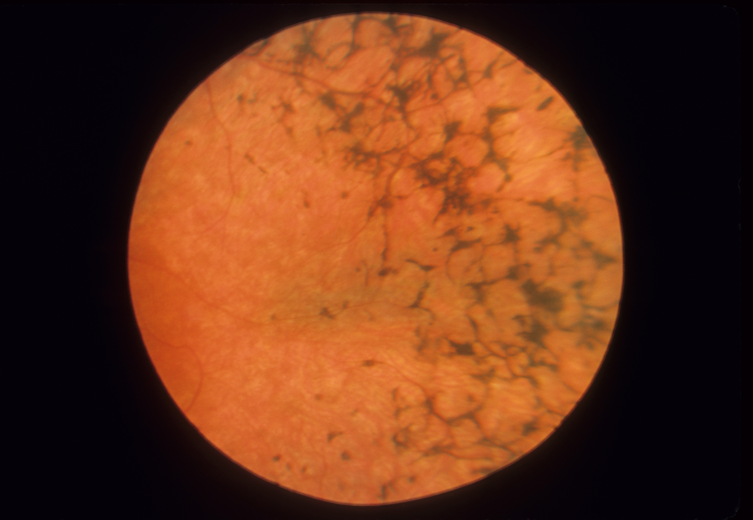 Воспаление сетчатки. Пигментный ретинит сетчатки. Пигментный ретинит и абиотрофия сетчатки. Абиотрофия сетчатки костные тельца. Ретинит (пигментная дистрофия сетчатки).